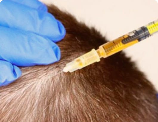 VLCC prp hair treatment solution for hair growth